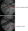 Images tomographiques reconstruites à deux profondeurs dans une rétine de (...)